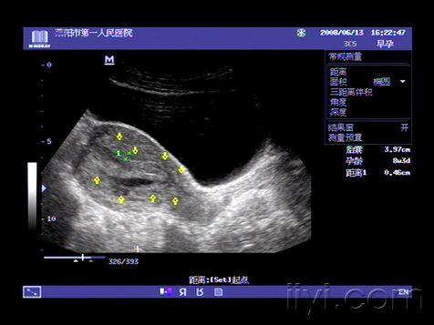 典型纵隔子宫伴一侧宫腔内早孕请指正 超声医学讨论版 爱爱医医学