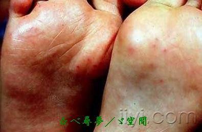 手足口病图片