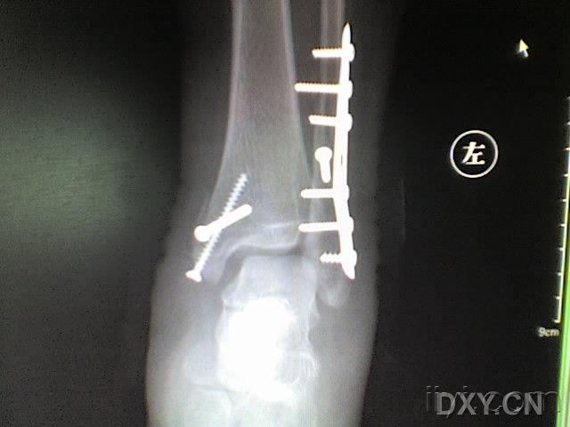 三踝骨折,术后后踝复位不满意,会否影响功能(图)