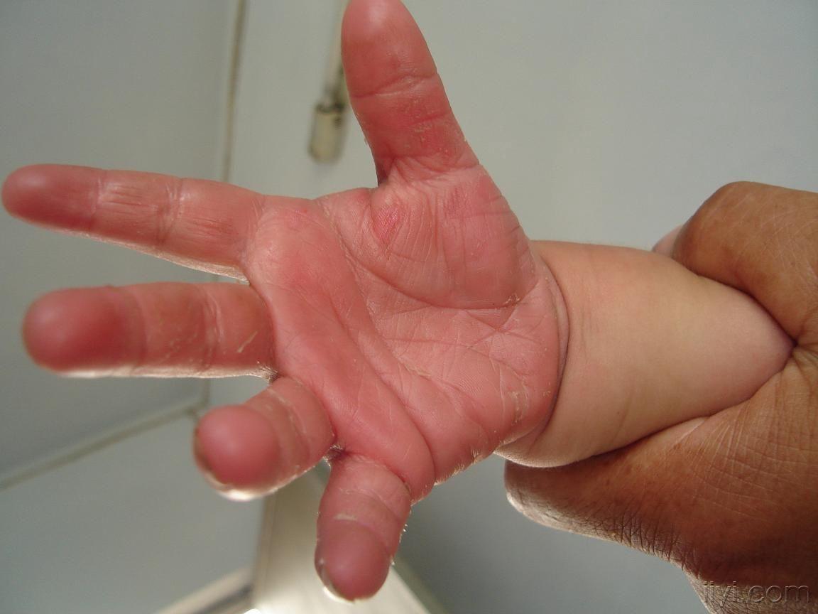 10:49:44患者,男,2岁,从3个月开始,双手掌及双脚掌红斑,伴脱皮