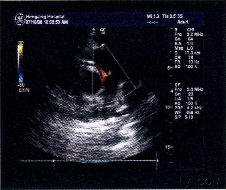 肺动脉瓣下异常血流? - 超声医学讨论版 - 爱爱医医学
