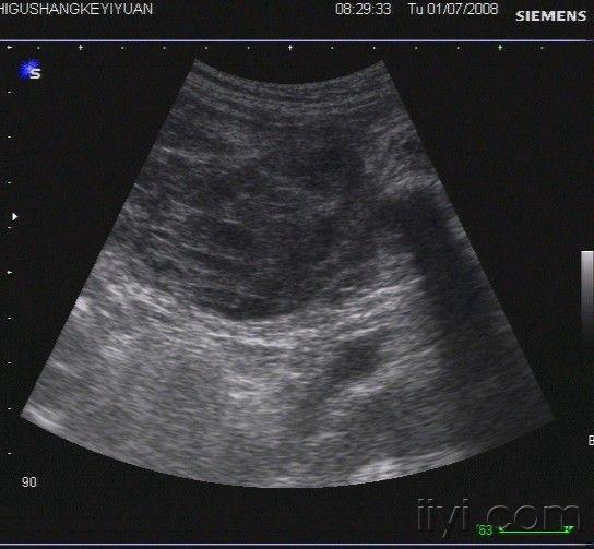 一例极易误诊的病例:自发性腹直肌鞘血肿 - 超声医学