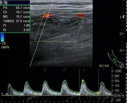 大家遇到上肢动脉呈单个波怎么报的啊(附图) - 超声医学讨论版 - 爱爱