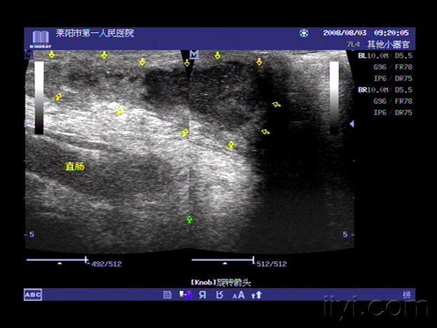 超声所见  :左侧阴囊外下方,直肠前方皮