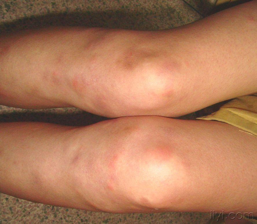 两下肢痛性结节半月余. - 皮肤及性传播疾病讨论版