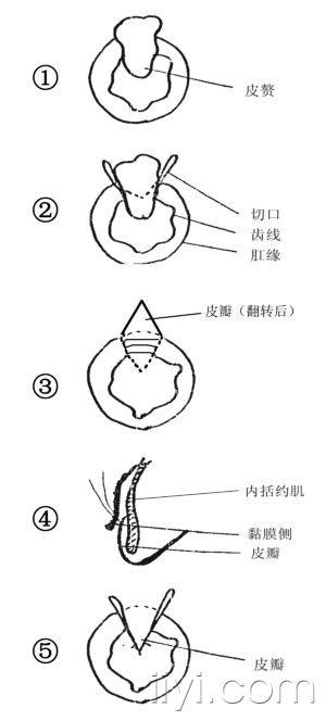 关键词:痔   皮瓣  肛门   整形术.