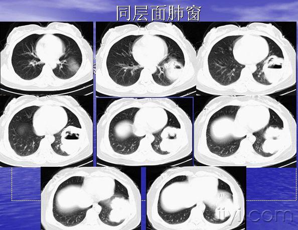 [讨论]肺脓肿?肺癌?有病理结果(结果已出,出乎意料,进来看看)