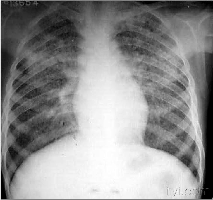 征求心胸x线片,有分加!