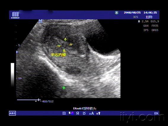 【分享】典型病例-不完全性流产 超声医学讨论版 爱爱医