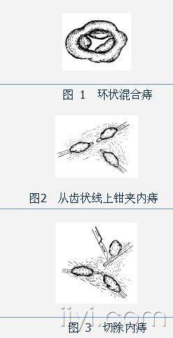 使用滑动皮瓣的痔手术