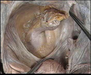 女性盆腔解剖——清晰显露输尿管,子宫位置关系