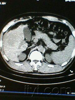 左叶肝癌,右叶局限性脂肪浸润,肝硬化