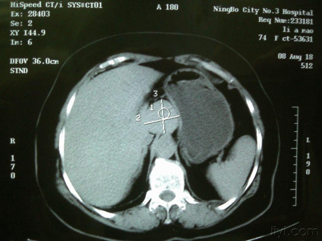 肝胃间隙占位(付ct)