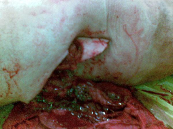 左大腿下端内侧可见股骨断端外露,局部大量出