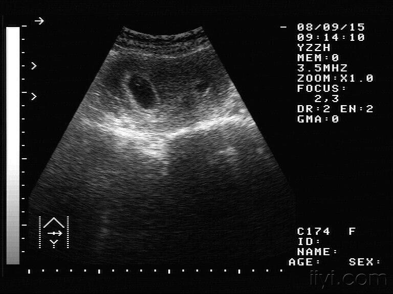 【讨论】是不是双角子宫 - 超声医学讨论版 - 爱爱医