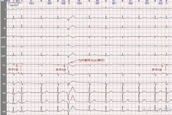 房早伴差传? - 心电图脑电图专业讨论版 - 爱爱医医学