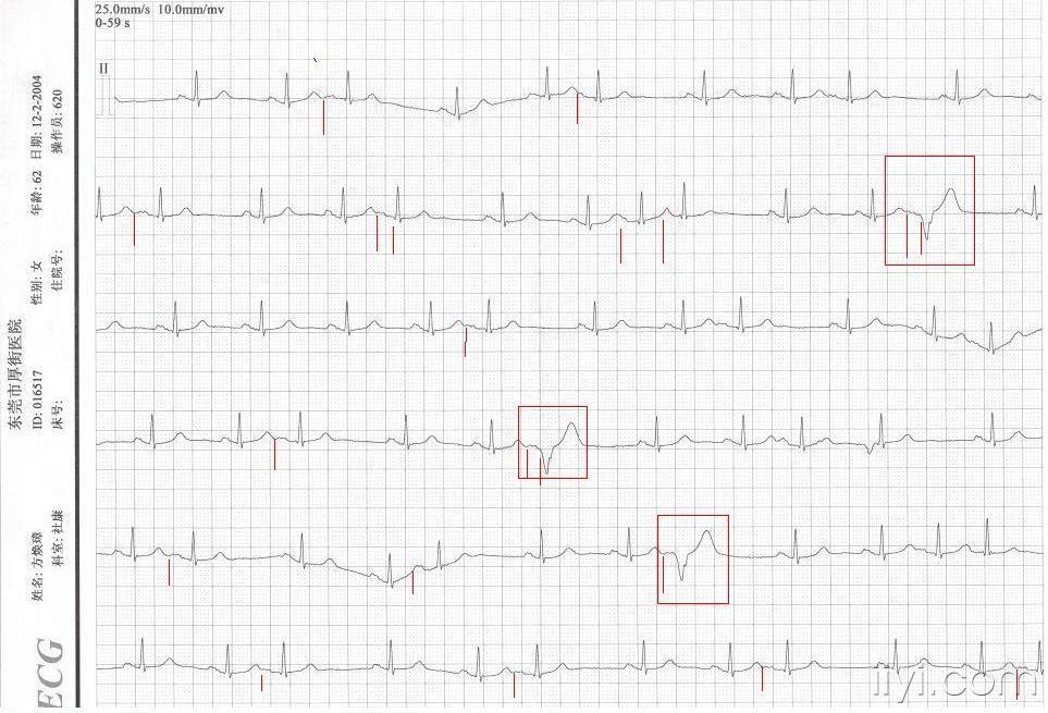 房早伴差传? - 心电图脑电图专业讨论版 - 爱爱医医学