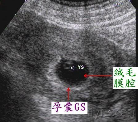 早孕结构(9月22日整理版 超声医学讨论版 爱爱医医学论坛 爱爱