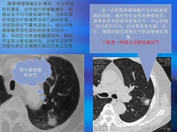 【专题】周围型肺癌ct影像征(病理基础,影像表现,鉴别