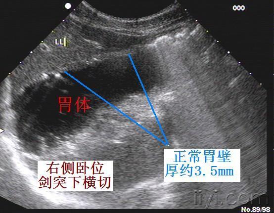 正常胃超声图像(10月8日更正)