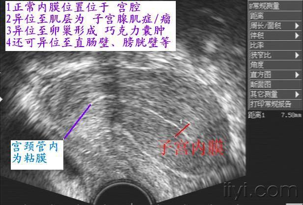 正常子宫和卵巢图片集