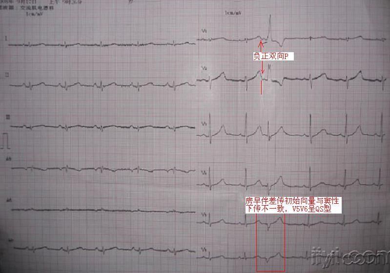 房早伴差传? - 心电图脑电图专业讨论版 - 爱爱医医学