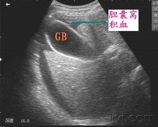 迟发性脾破裂(10月4日更正) - 超声医学讨论版 - 爱爱