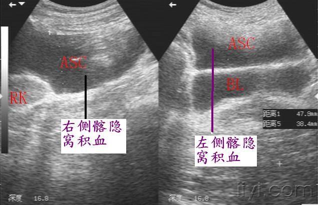 迟发性脾破裂(10月4日更正) - 超声医学讨论版 - 爱爱