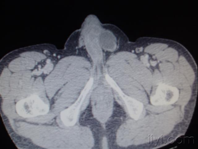 男性腹股沟疝与睾丸鞘膜积液在ct图象上的表现!