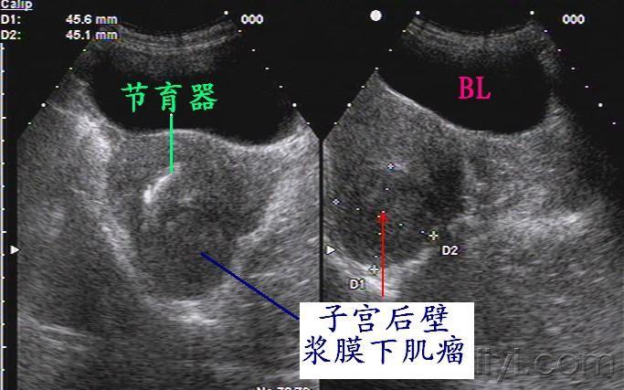 (原创)子宫三部位肌瘤