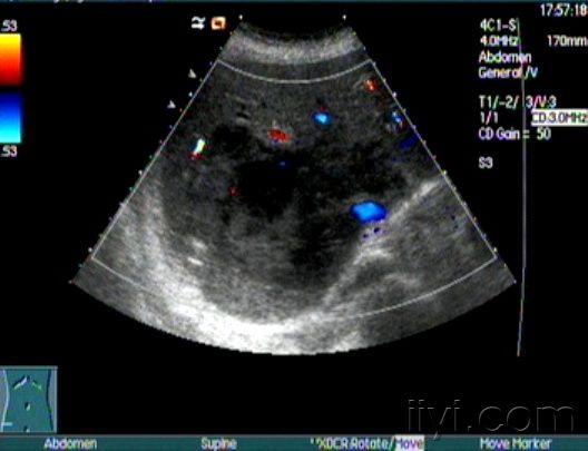 糖尿病并含气肝脓肿 - 超声医学讨论版 - 爱爱医医学
