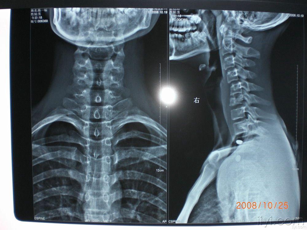 沙发回复haidong999颈椎mri还有    由于上传慢  先上传颈椎x线  [ 本