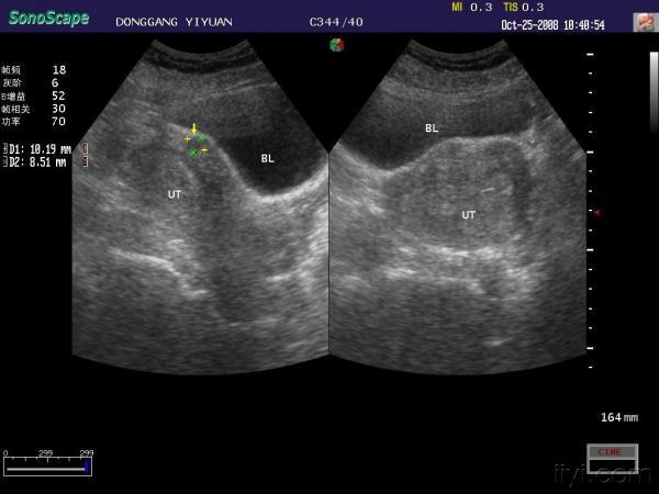 双角子宫 - 超声医学讨论版 - 爱爱医医学论坛 - 爱爱