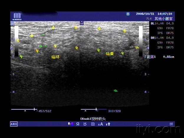 典型病例-----腹股沟斜疝(易复性)请欣赏 - 超声医学
