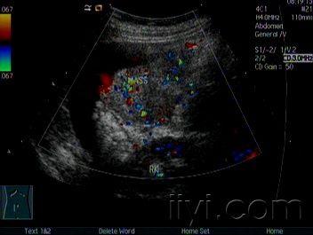 1例卵巢癌大网膜转移癌的超声声像图