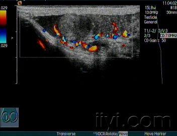 右侧附睾结节 超声医学讨论版 爱爱医医学论坛 爱爱医医学网