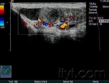 右侧附睾结节 超声医学讨论版 爱爱医医学论坛 爱爱医医学网