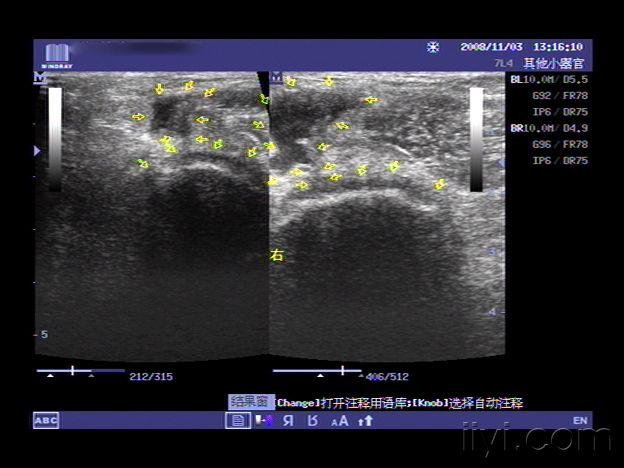 腘窝囊肿 - 超声医学讨论版 - 爱爱医医学论坛 - 爱爱医医学网