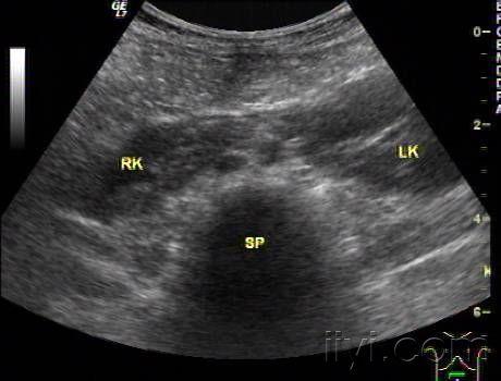 马蹄肾一例 - 超声医学讨论版 - 爱爱医医学论坛 - 医