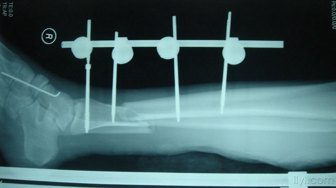 入院后行急诊手术(右小腿,右足清创,胫骨骨折复位外支架固定,第一锲