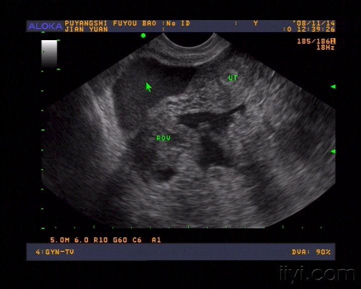 典型的黄体破裂,大家共赏 - 超声医学讨论版 - 爱爱医