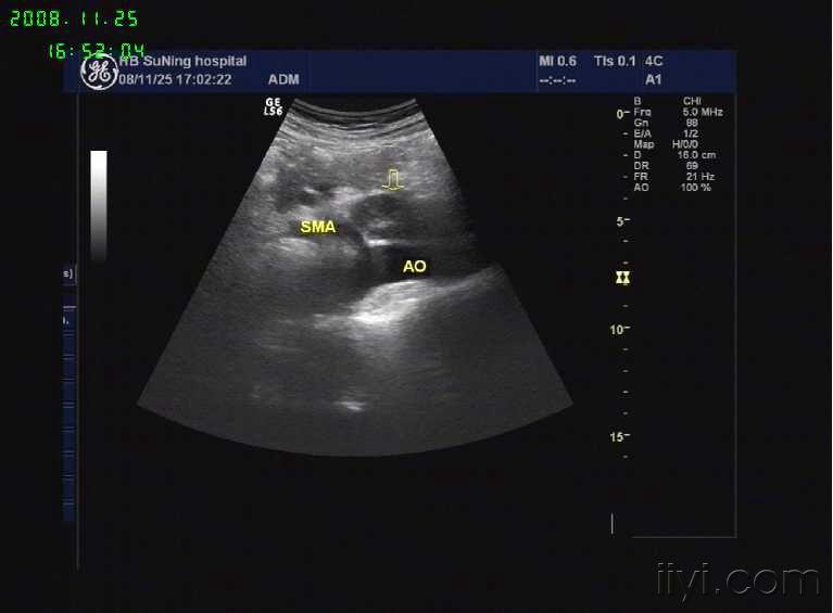 左肾静脉血栓形成 超声医学讨论版 爱爱医医学论坛 爱爱医医学