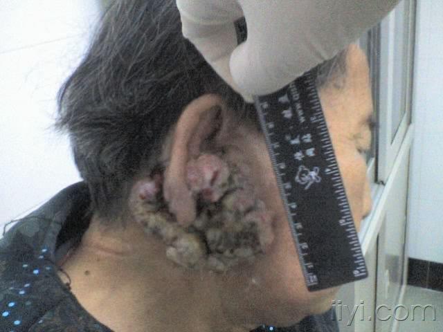 58李某某 ,女 ,76岁 ,因右耳肿物9年余入院  病人9年前无意中发现右耳