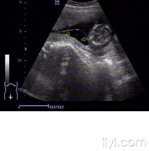 【共享】典型图片之:羊膜绒毛膜未融合 - 超声医学版