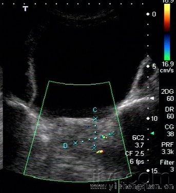 前列腺ca图 超声医学资源版 爱爱医医学论坛 爱爱医医学网