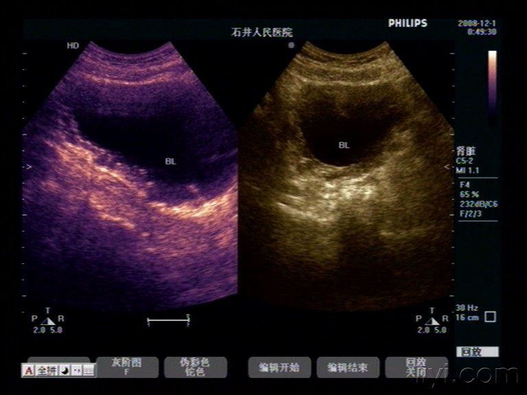 腺性膀胱炎 - 超声医学讨论版 - 爱爱医医学论坛 - 医