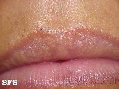 皮脂腺异位症异位在唇颊粘膜有什么好办法?