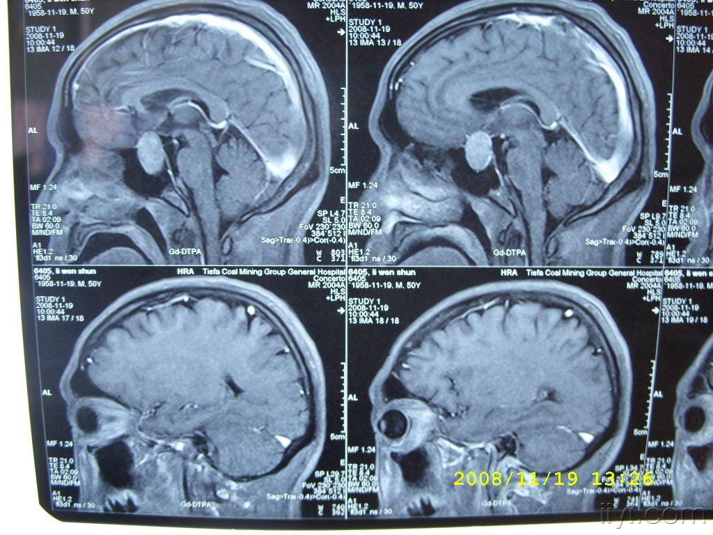 典型垂体瘤一例赏析