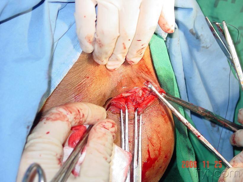 直肠脱垂肛门失禁的注射和括约肌折叠术