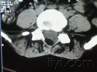 腰椎脊膜膨出症一例.